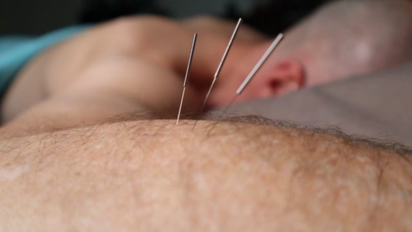 Akupuntur (Chinese Medicine Podcast Podcast @Pexels)